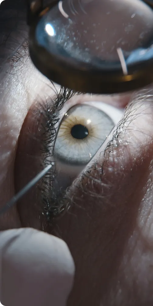 bladeless eye surgery