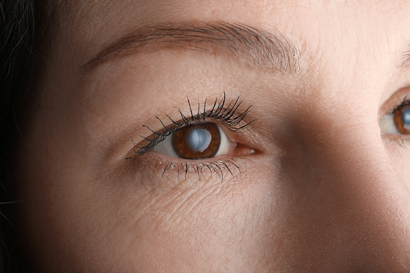 Closeup view of woman suffering from cataract
