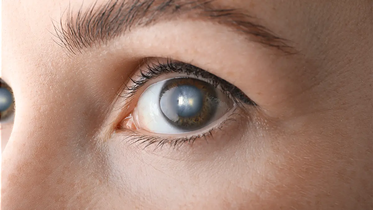 When Is the Right Time to Consider Cataract Removal?