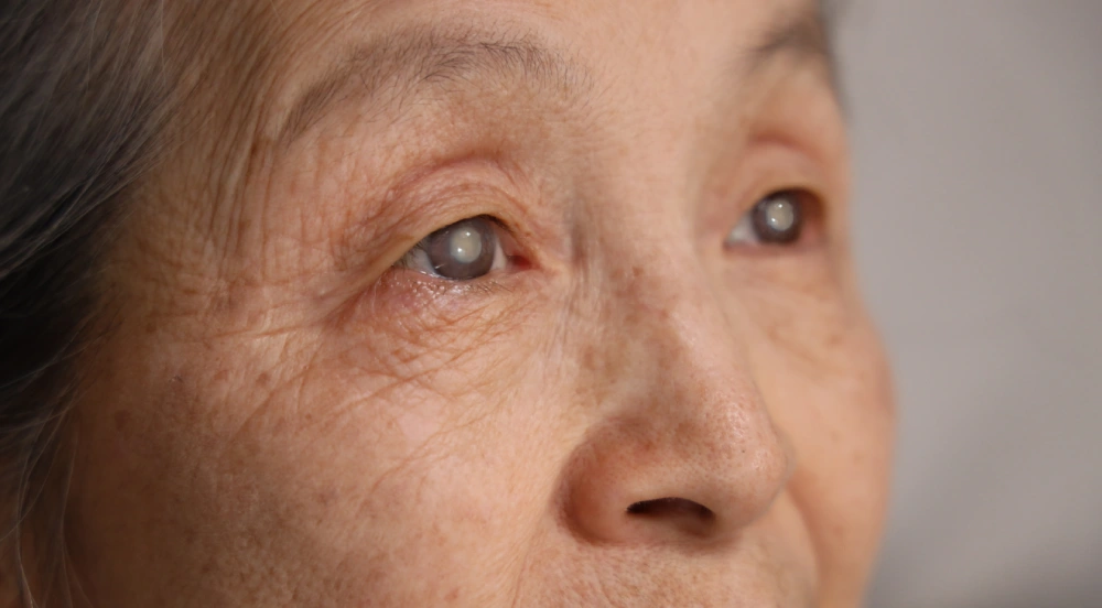 Close-up of a female patient's eyes before cataract surgery.