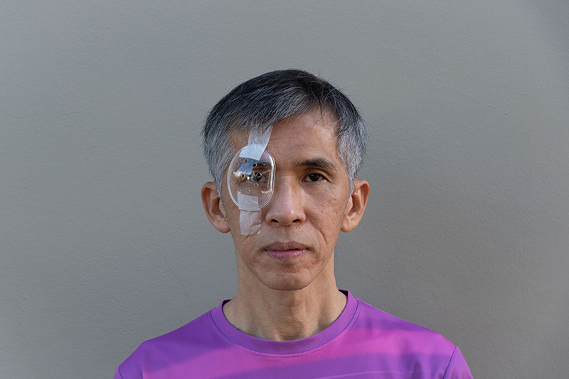 A man with a protective eye shield after cataract surgery