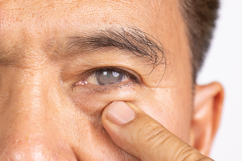 A man with cataracts before cataract surgery